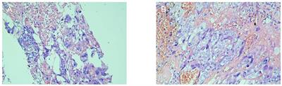 Frontiers Case Report Metastatic Choriocarcinoma In The Second